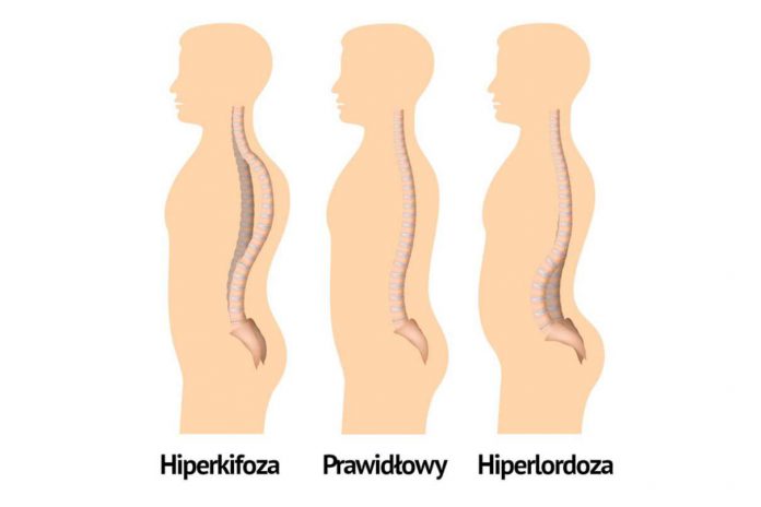 Hiperlordoza