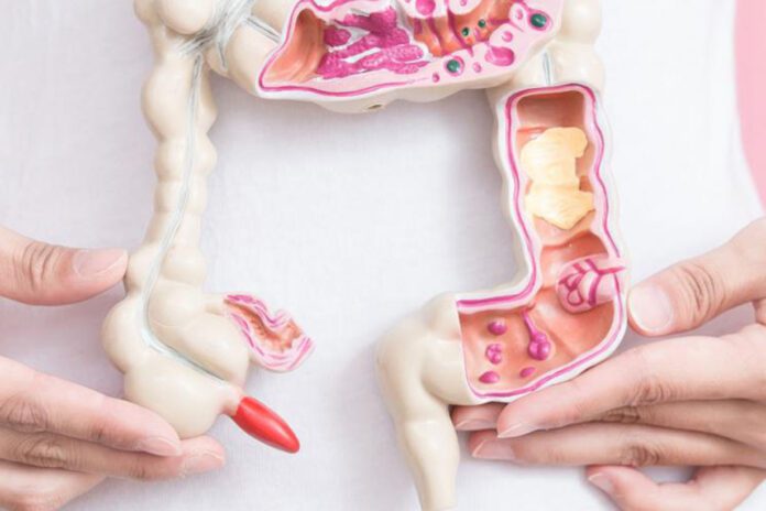 Rak jelita grubego - badanie